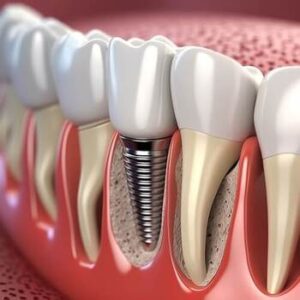 Single Tooth Implant Cost Australia image broadford