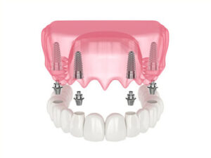 all 4 dental implants cost image broadford