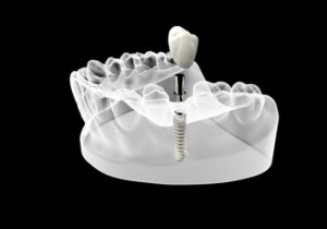 single-tooth-implant-cost-australia-illustration-broadford